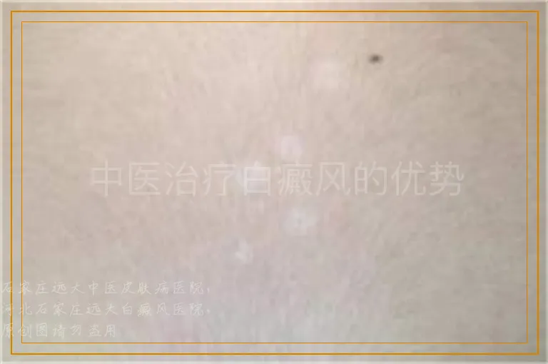 中医治疗白癜风的优势