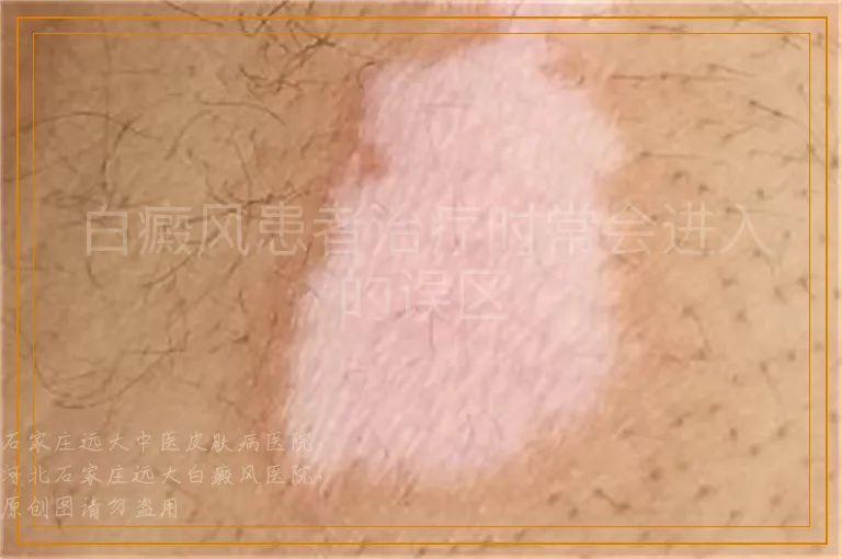 白癜风患者治疗时常会进入的误区