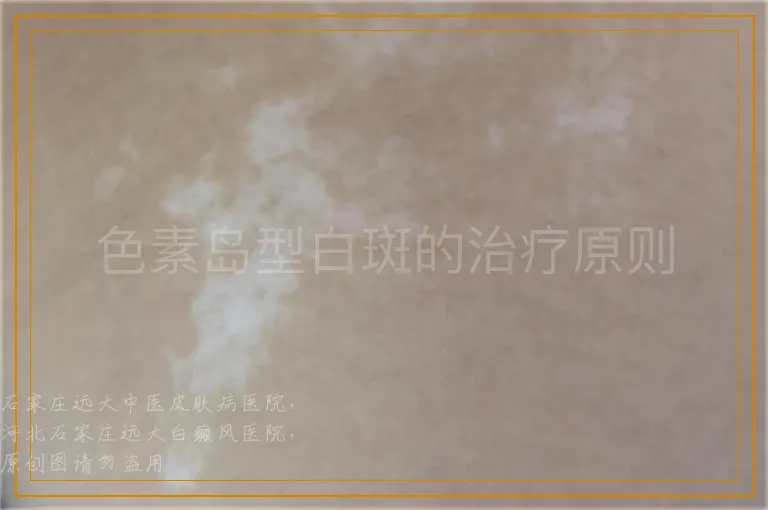 色素岛型白斑的治疗原则