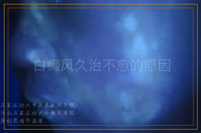 白癜风久治不愈的原因