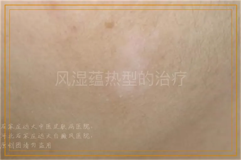 风湿蕴热型的治疗