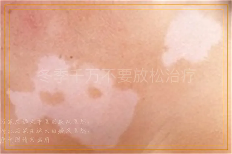 冬季千万不要放松治疗