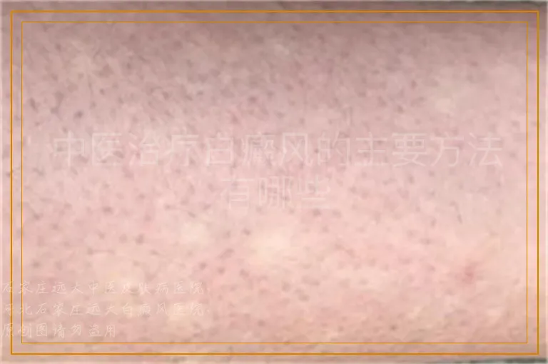 中医治疗白癜风的主要方法有哪些