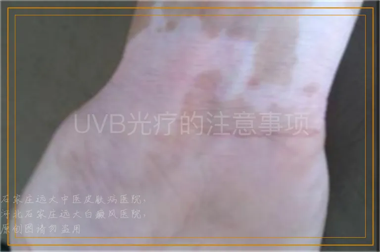 UVB光疗的注意事项