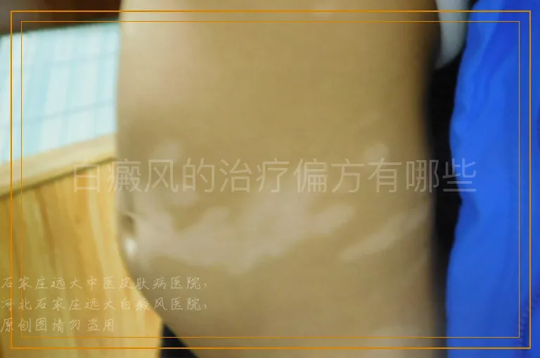 白癜风的治疗偏方有哪些