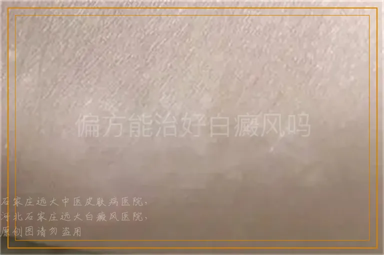 偏方能治好白癜风吗
