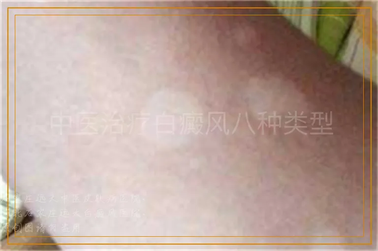 中医治疗白癜风八种类型