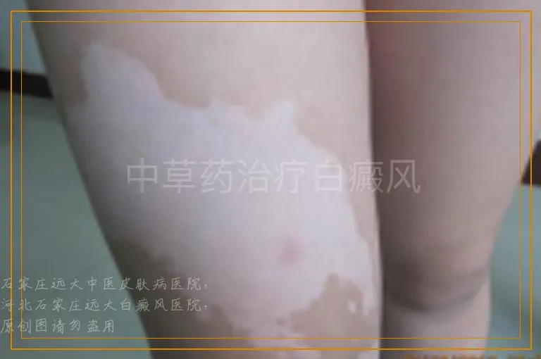 中草药治疗白癜风