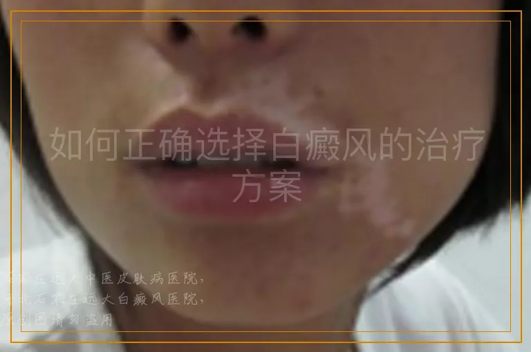 如何正确选择白癜风的治疗方案