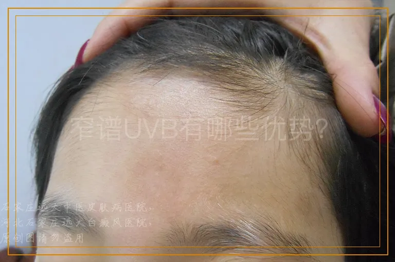 窄谱UVB有哪些优势？