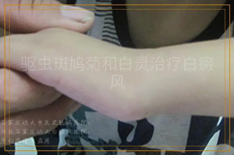 驱虫斑鸠菊和白灵治疗白癜风