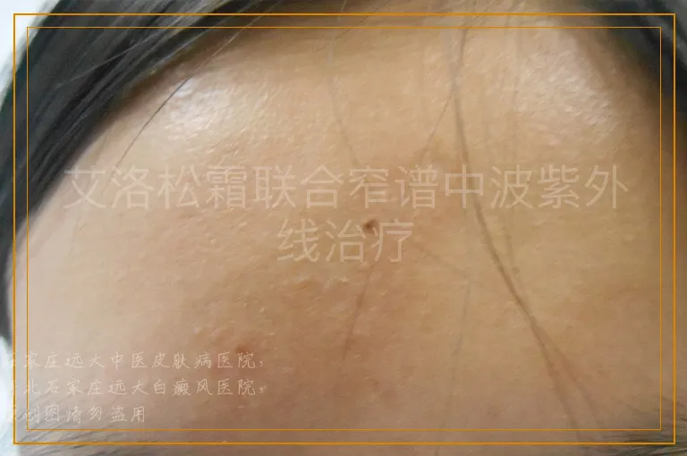 艾洛松霜联合窄谱中波紫外线治疗
