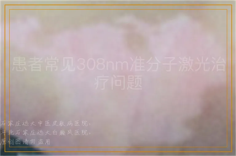 患者常见308nm准分子激光治疗问题