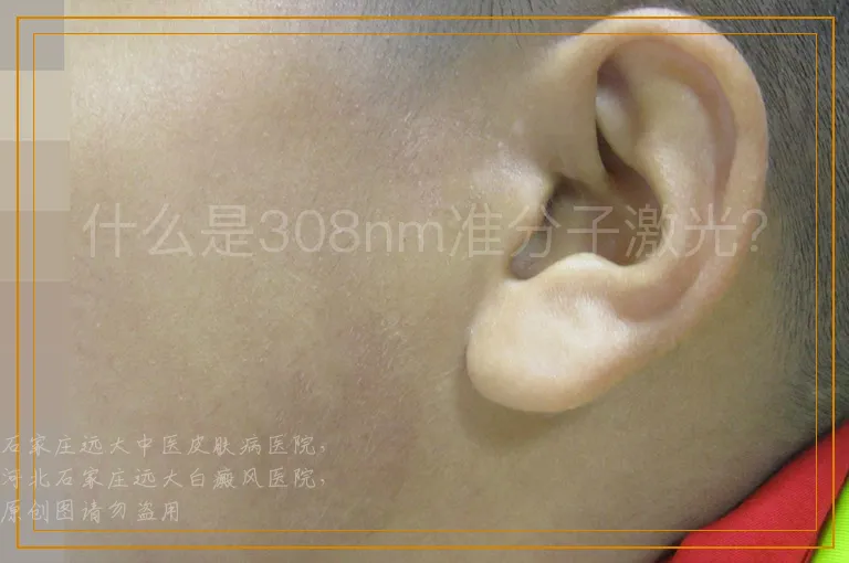 什么是308nm准分子激光？
