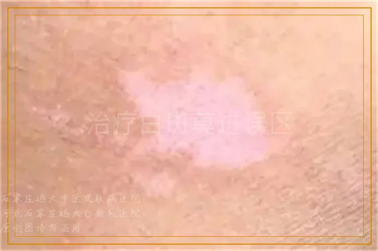 治疗白斑莫进误区