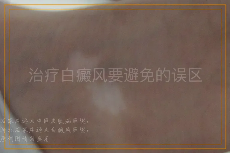 治疗白癜风要避免的误区