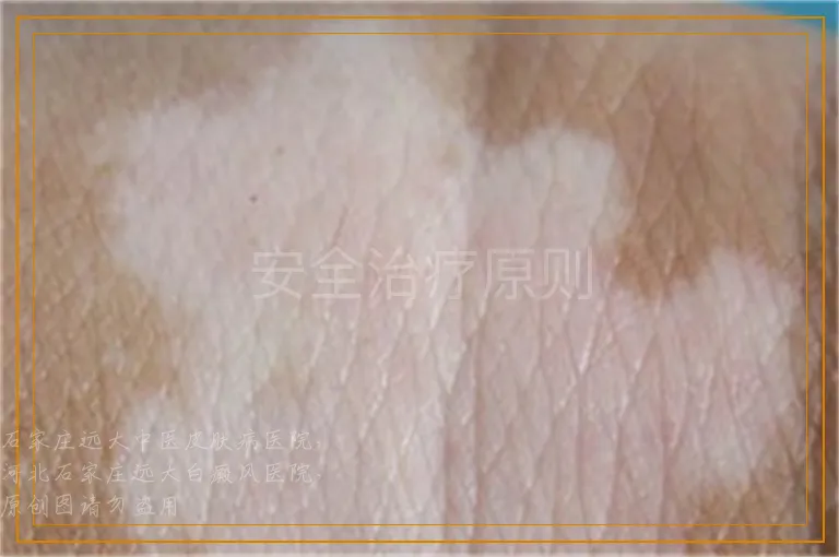 安全治疗原则