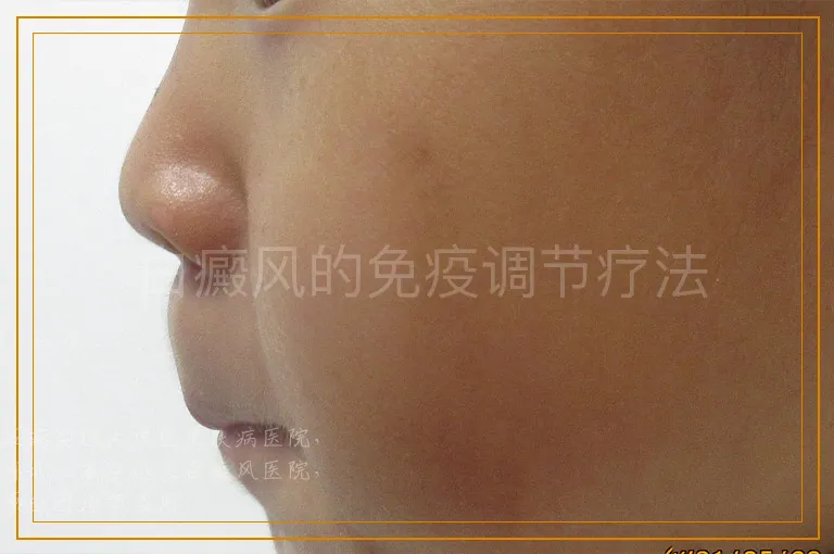 白癜风的免疫调节疗法