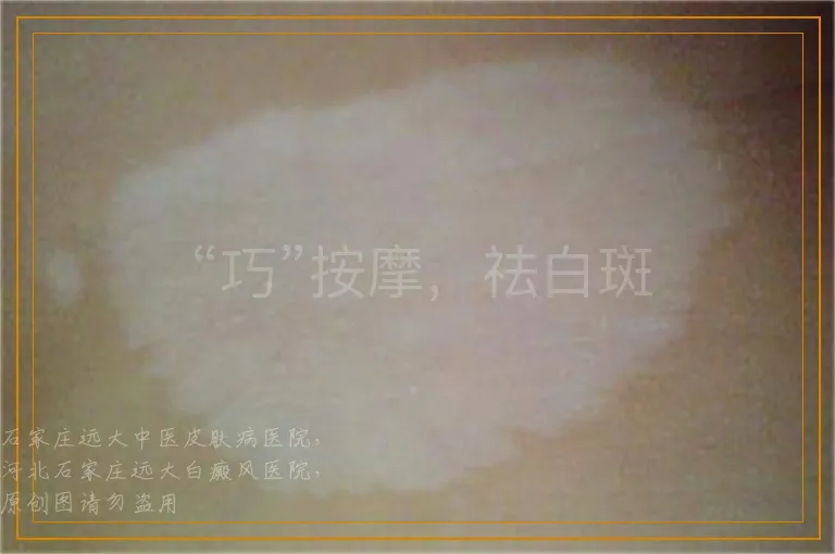 “巧”按摩，祛白斑