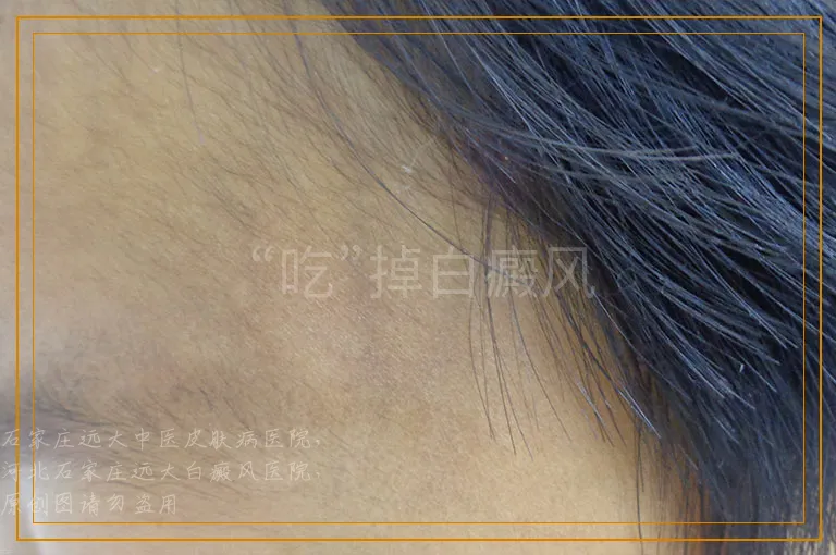 “吃”掉白癜风