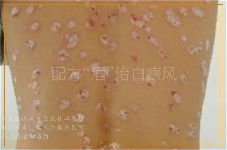 配方“酒”治白癜风