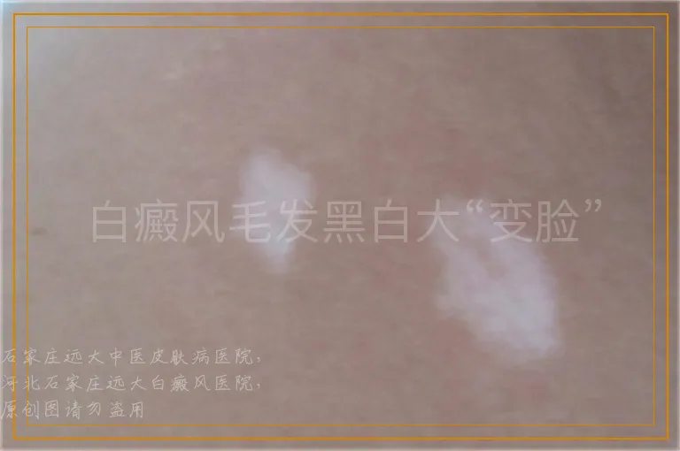 白癜风毛发黑白大“变脸”