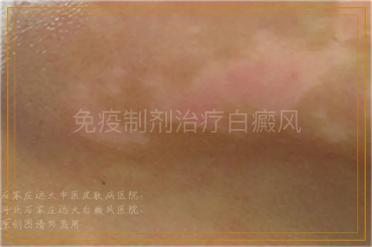 免疫制剂治疗白癜风