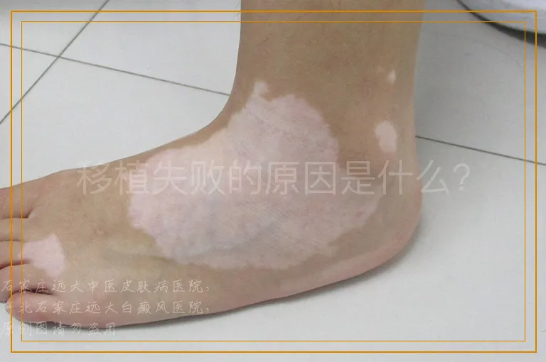 移植失败的原因是什么？