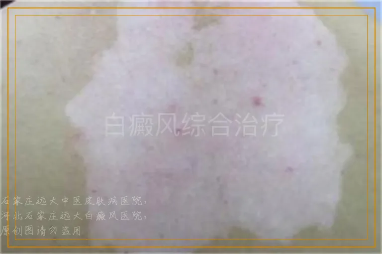 白癜风综合治疗