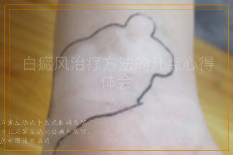 白癜风治疗方法的几点心得体会