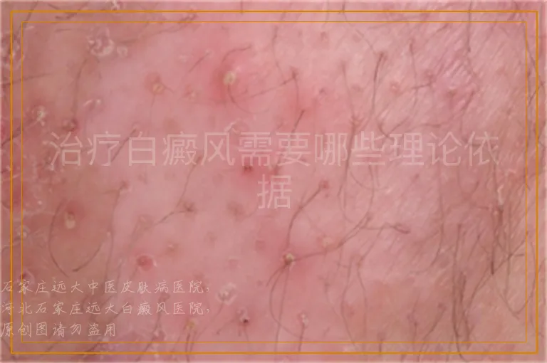 治疗白癜风需要哪些理论依据