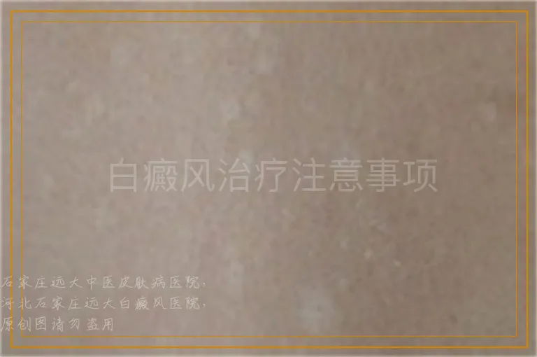 白癜风治疗注意事项