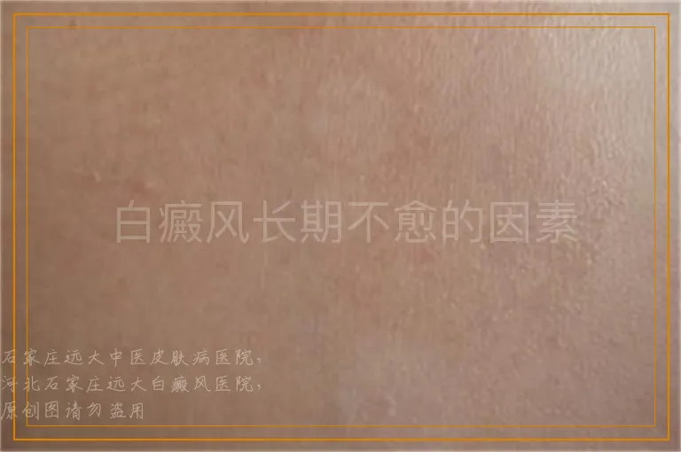 白癜风长期不愈的因素
