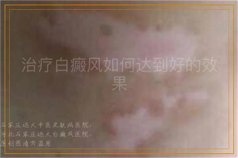 治疗白癜风如何达到好的效果