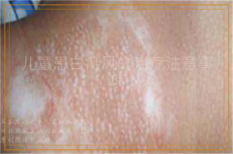 儿童患白癜风的治疗注意事项