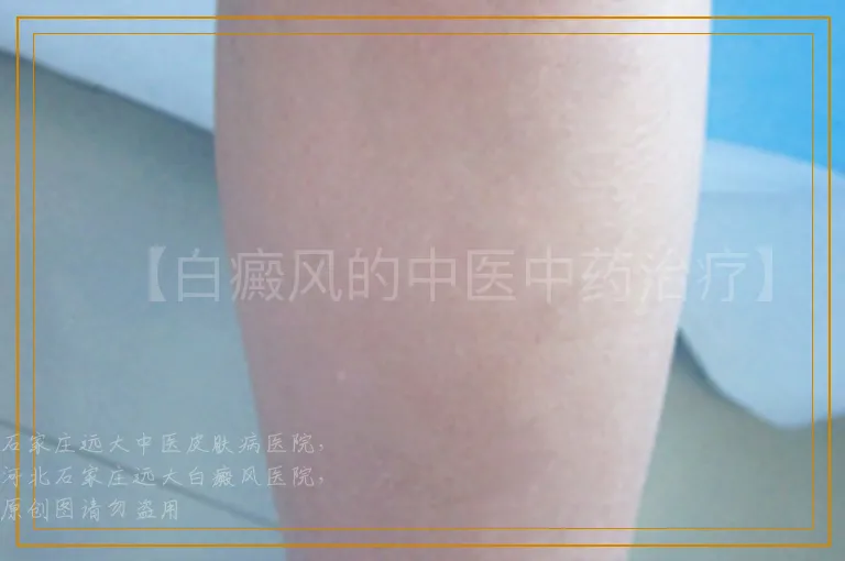 【白癜风的中医中药治疗】