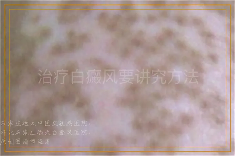 治疗白癜风要讲究方法