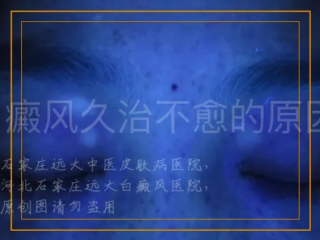 白癜风久治不愈的原因？