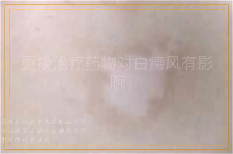更换治疗药物对白癜风有影响
