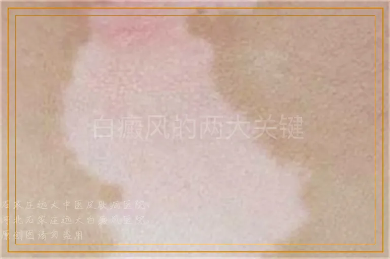 白癜风的两大关键
