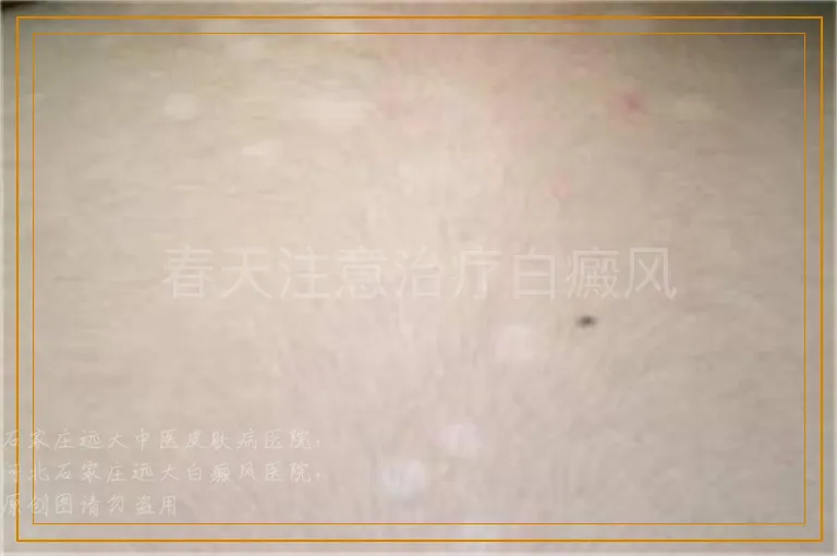 春天注意治疗白癜风