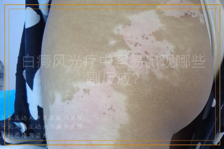 白癜风光疗中容易出现哪些副反应？