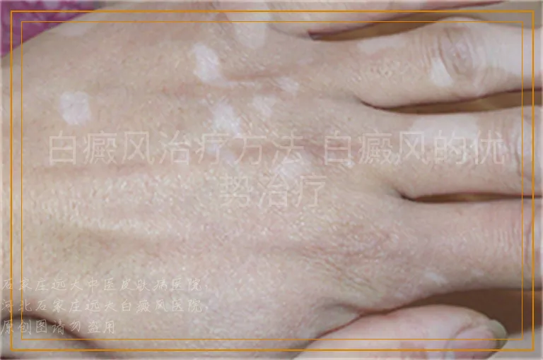 白癜风治疗方法 白癜风的优势治疗