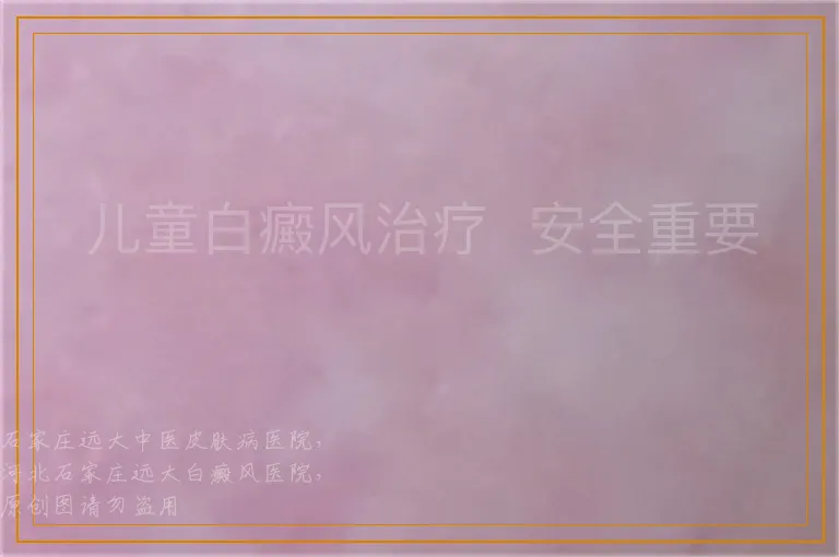 儿童白癜风治疗  安全重要