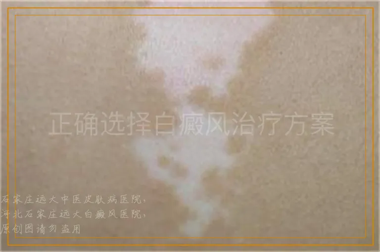 正确选择白癜风治疗方案