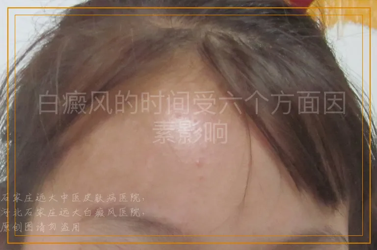 白癜风的时间受六个方面因素影响