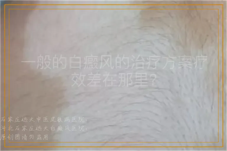 一般的白癜风的治疗方案疗效差在那里？