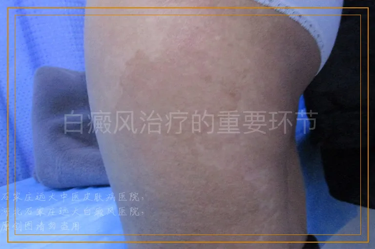 白癜风治疗的重要环节