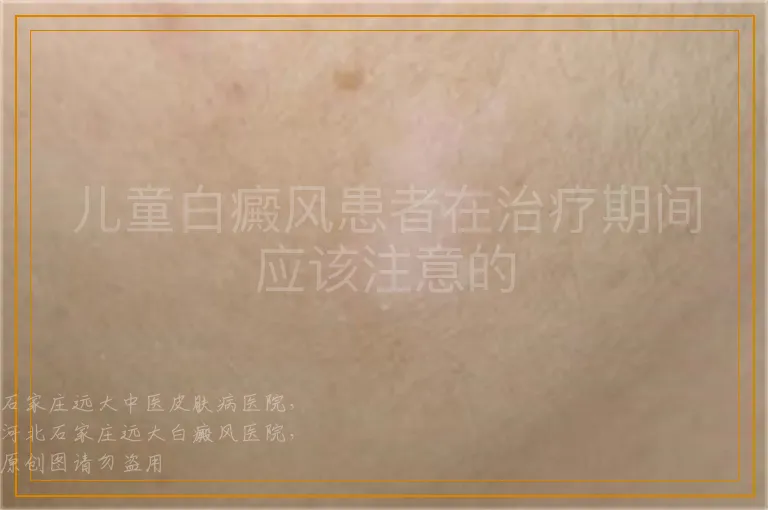 儿童白癜风患者在治疗期间应该注意的