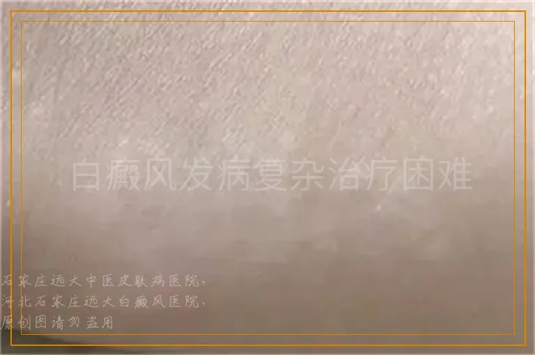 白癜风发病复杂治疗困难